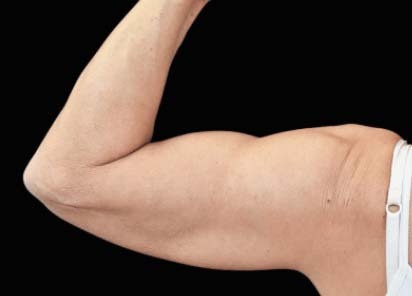 Emsculpt_PIC_080-After-biceps-female-Bruce-E-Katz-MD-4TX_412x296_1589434146_original_New