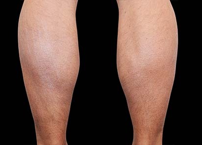 Emsculpt_PIC_082-After-calves-male-Reminder-Saluja-MD-4TX_412x296_1589434998_original_New