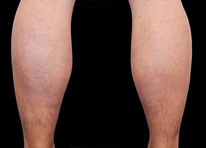 Emsculpt_PIC_082-Before-calves-male-Reminder-Saluja-MD_412x296_1589435000_original_New