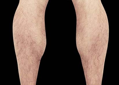 Emsculpt_PIC_083-After-calves-male-Reminder-Saluja-MD-4TX_412x296_1589435001_original_New