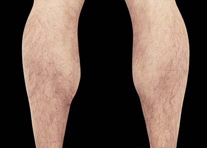 Emsculpt_PIC_083-After-calves-male-Reminder-Saluja-MD-4TX_412x296_1616751147_original_New