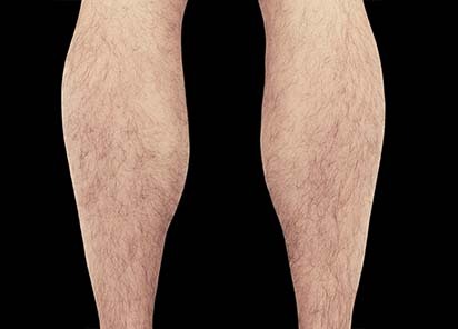 Emsculpt_PIC_083-Before-calves-male-Reminder-Saluja-MD_412x296_1616751150_original_New