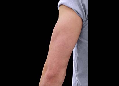 Emsculpt_PIC_085-after-triceps-male-Reminder-Saluja-MD-4TX_412x296_1589434426_original_New