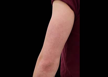 Emsculpt_PIC_085-before-triceps-male-Reminder-Saluja-MD-4TX_412x296px_1589434427_original_New