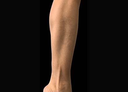 Emsculpt_PIC_087-After-calves-female-Reminder-Saluja-MD-4W-4TX_412x296px_1602658339_original_New
