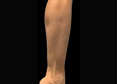 Emsculpt_PIC_087-Before-calves-female-Reminder-Saluja-MD_412x296px_1602658340_original_New