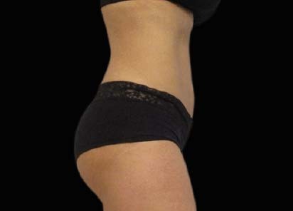 Emsculpt_PIC_093-After-abdomen-female-Michaela-Persky-MD_412x296px_1602658254_original