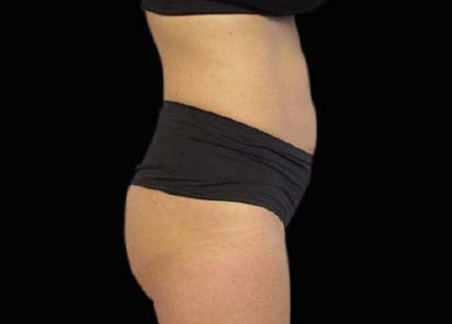 Emsculpt_PIC_093-Before-abdomen-female-Michaela-Persky-MD_412x296px_1602658256_original