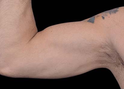 Emsculpt_PIC_098-after-biceps_male-Barry-DiBernardo-MD-4TX_412x296px_1616750693_original_New