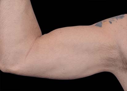 Emsculpt_PIC_098-before-biceps_male-Barry-DiBernardo-MD-4TX_412x296_1616750688_original_New