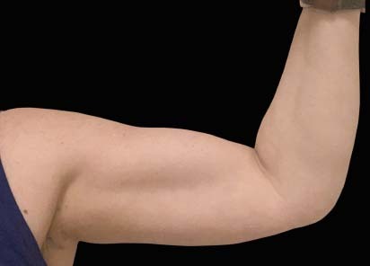 Emsculpt_PIC_113-after-biceps_female-BTL-Aesthetics-3W-2TX_412x296px_1589434152_original_New