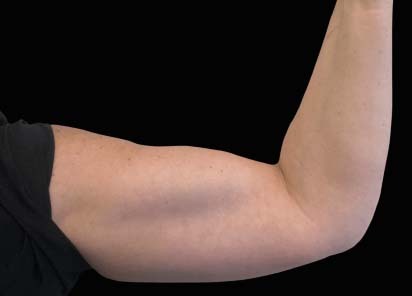 Emsculpt_PIC_113-before-biceps_female-BTL-Aesthetics_412x296px_1589434154_original_New