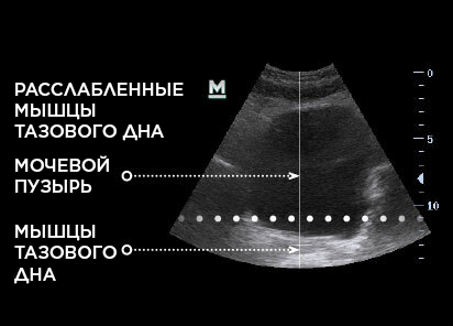 Emsella_PIC_Ba-before-female-pelvic-floor-ultrasound_RU100_412x296_1643723930_original