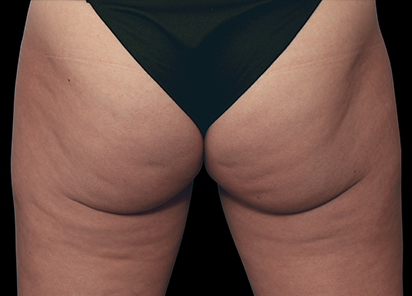 До процедур EMTONE