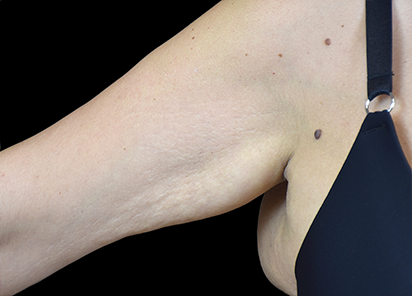 После 4 процедур EMTONE