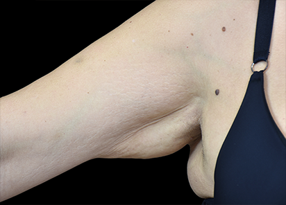 До процедур EMTONE