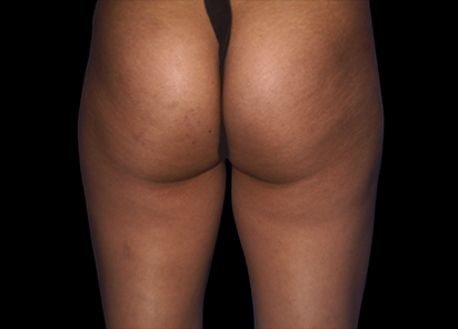 После 4 процедур EMTONE