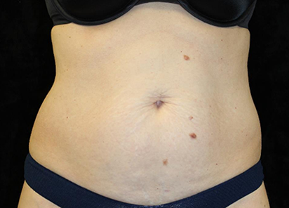 После 4 процедур EMTONE