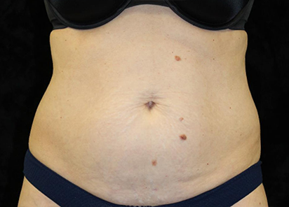 До процедур EMTONE