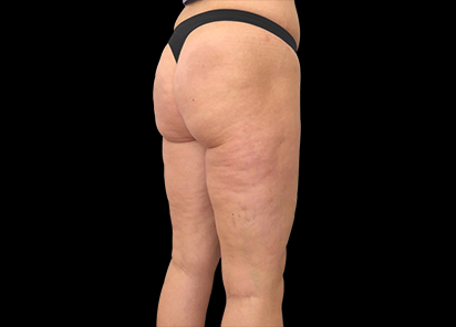 До процедур EMTONE