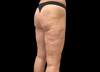 До процедур EMTONE