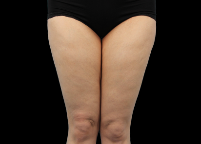 После процедуры EMTONE