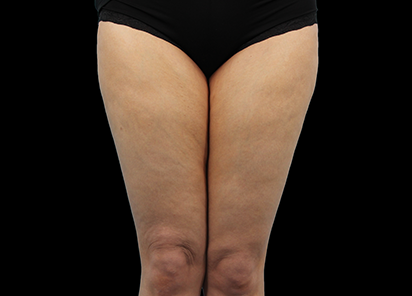 До процедур EMTONE