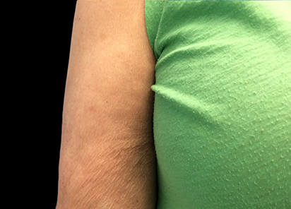 После 4 процедур EMTONE