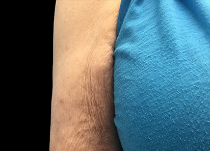 До процедур EMTONE