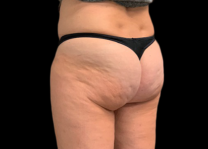 До процедур EMTONE