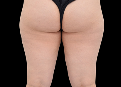 После 4 процедур EMTONE