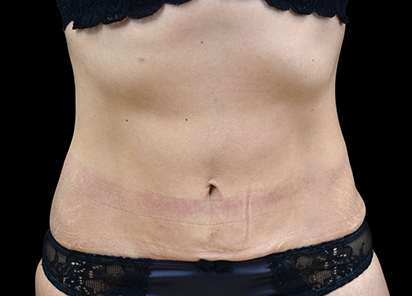 После 4 процедур EMTONE