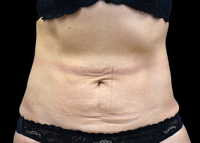 До процедур EMTONE