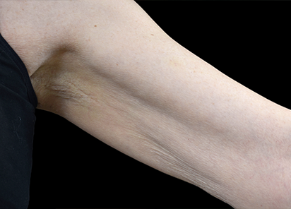 До процедур EMTONE