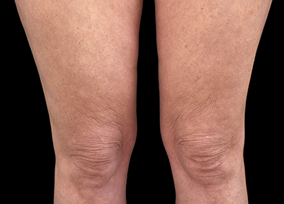 После 4 процедур EMTONE