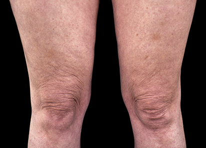 До процедур EMTONE