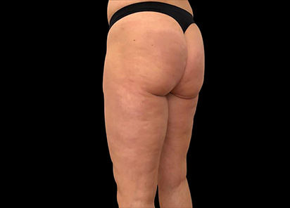 После 3 процедур EMTONE