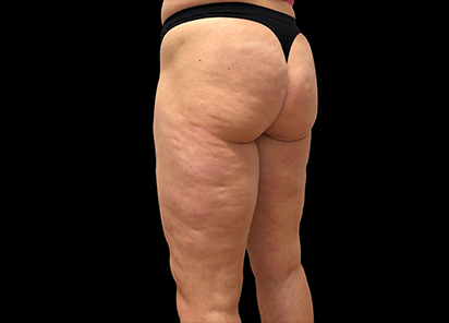 До процедур EMTONE