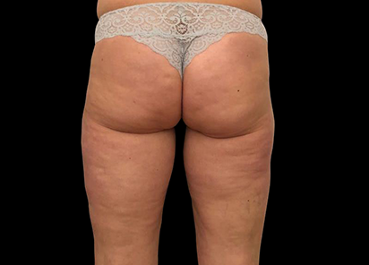 После 4 процедур EMTONE