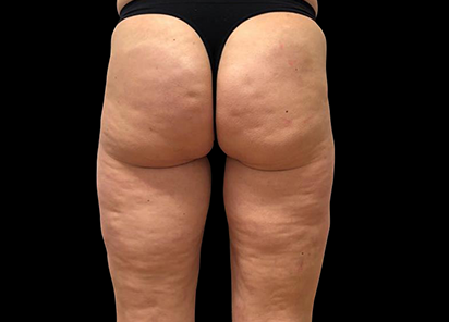 До процедур EMTONE