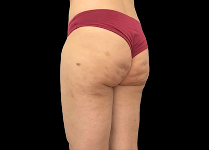 После 3 процедур EMTONE