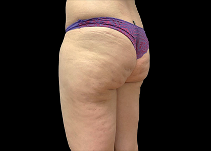 До процедур EMTONE