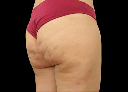 После 4 процедур EMTONE