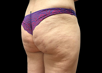 До процедур EMTONE