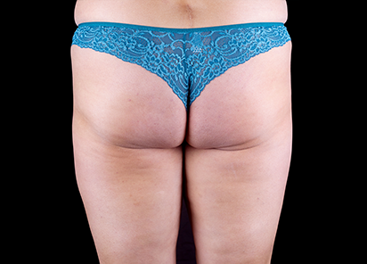 После 4 процедур EMTONE