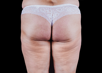 До процедур EMTONE