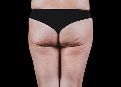 Emtone_PIC_35-Before-buttock-female-Brian-Kinney_412x296