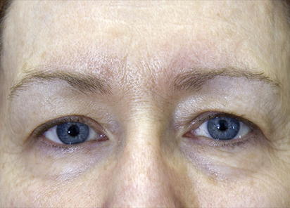 После 2 процедур EXILIS