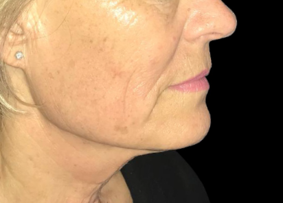 После 4 процедур EXILIS