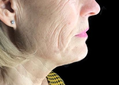 До процедур EXILIS